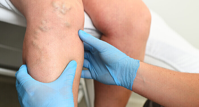 plan sur les mains d'un médecin examinant des varices sur la jambe d'une patiente