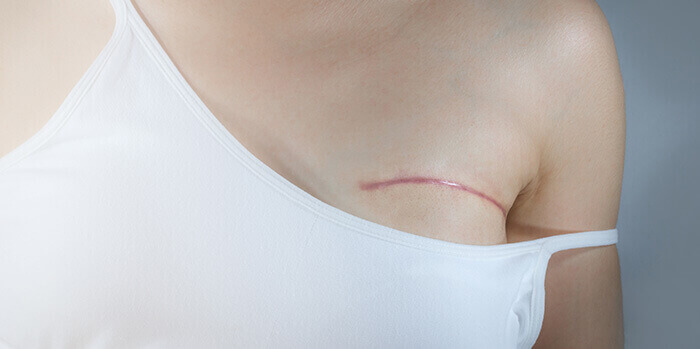 gros plan sur une cicatrice après une chirurgie dans le cadre d'un cancer du sein