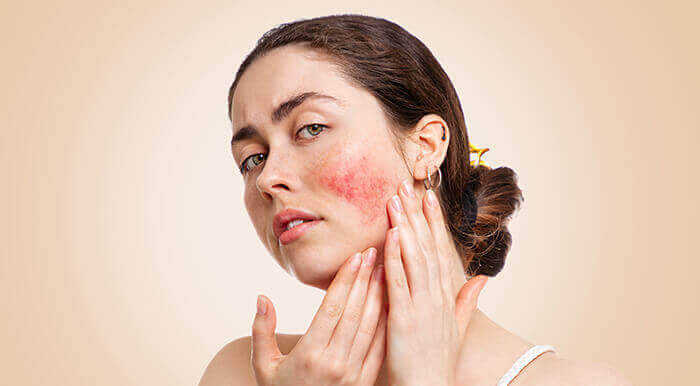 Visage de femme atteinte de rosacée au niveau des joues