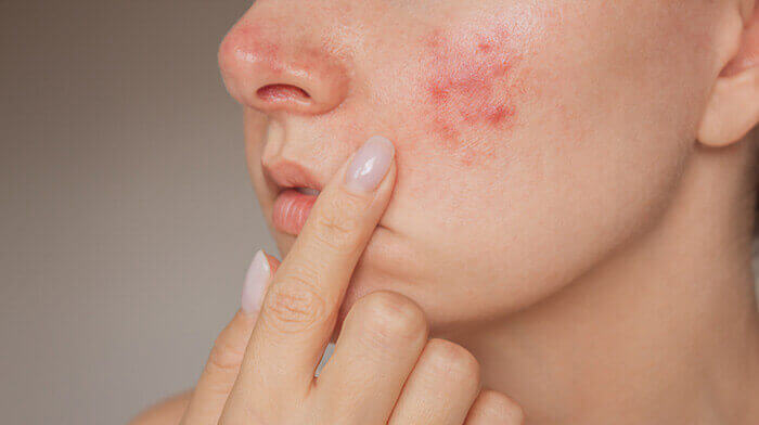 Plan sur une poussée de rosacée papulo-pustuleuse