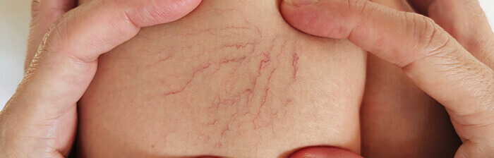 gros plan sur des varices