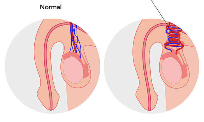 schéma d'un testicule normal et d'un testiculaire atteint présentant une torsion testiculaire