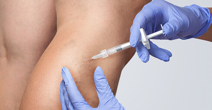 gros plan sur une injection dans la jambe dans le cadre d'un traitement des varices