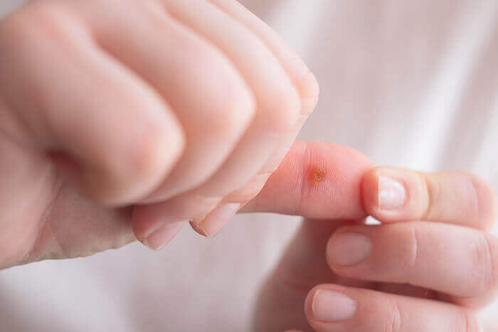 verrue au niveau du pouce