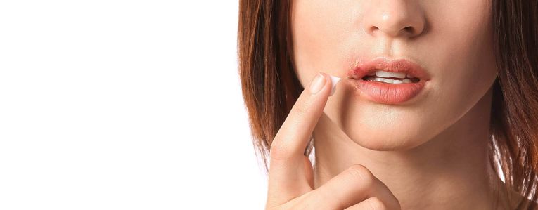 Comment faire disparaître un bouton de fièvre ?