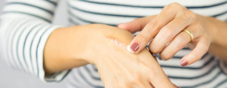 Comment soulager une brûlure superficielle ?