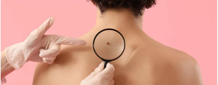 Le cancer de la peau sous toutes ses formes