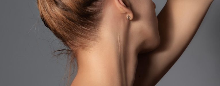 Pourquoi certaines cicatrices guérissent mal ?