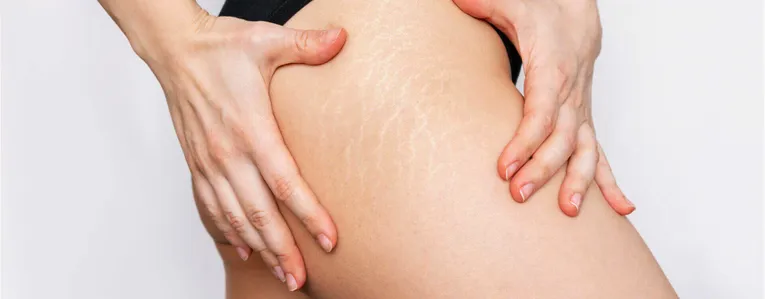 Quelle crème vergetures choisir ?