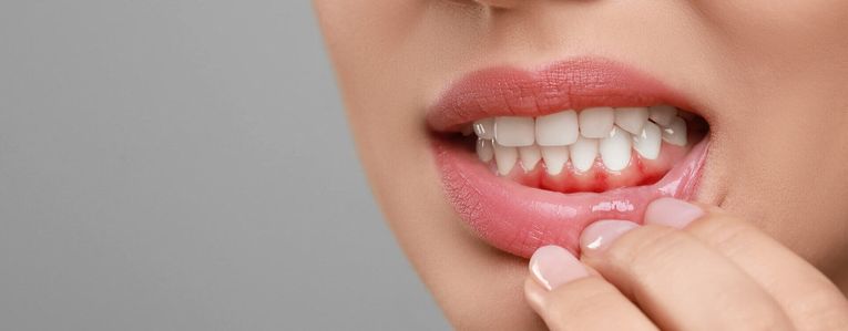 Comment soulager une gingivite ?