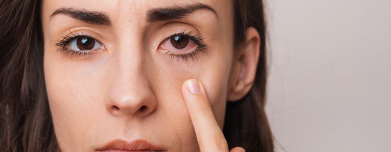 Comment soulager l'irritation oculaire ?