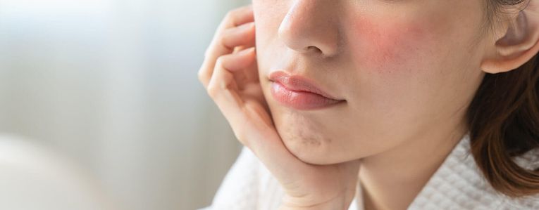 Que faire contre la rosacée ?