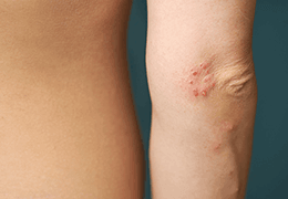 Comment traiter la gale ?