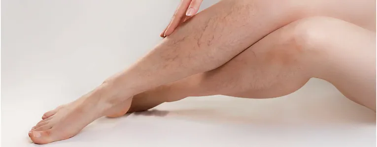 Varices, les traitements les plus efficaces