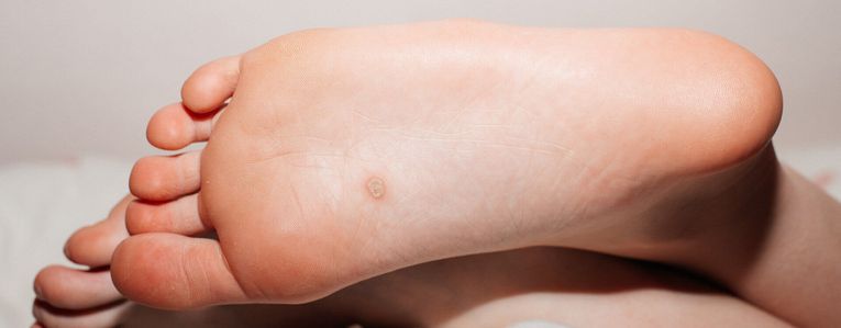 Comment traiter une verrue ?